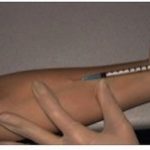 Injections intra-dermo Docteur Céline Palussière